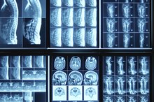 Advantages & Disadvantages of X-Rays
