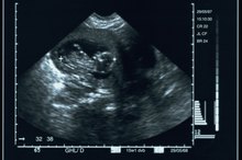 Causes of Fluid Around the Heart in a Fetus