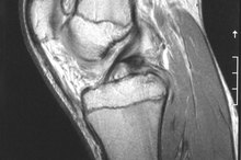Pain in the Knee & Occasional Popping When Walking