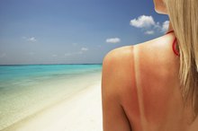 What is Sunburn?