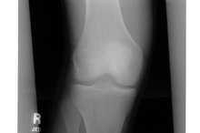 Lateral Collateral Ligament Pain From Running
