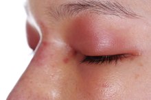 An Allergic Reaction That Causes the Eyes to Swell