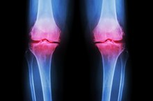 Joint Pain and a Vitamin Deficiency