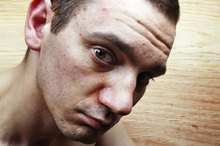 Diabetic Skin Acne
