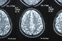 How Soon Can I Start Exercising After Brain Surgery?
