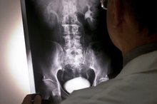 Orthopedic Shoes for Scoliosis