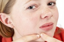 Are Brown Rice and Sweet Potatoes Good for Acne?