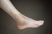 Causes of Swelling in Legs, Hands & Feet