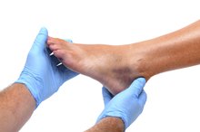 Degrees of Ankle Sprain