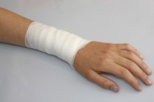 How to Prevent a Burn From Leaving a Scar