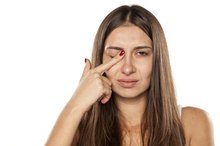 Itchy Eyelash Follicles