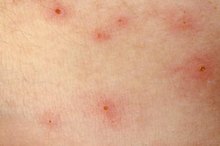 What Are Raised Bumps on the Skin?