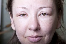 Inflamed Eye Membrane Causes