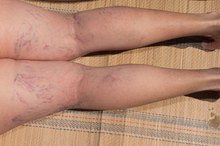 Popliteal Aneurysm Symptoms