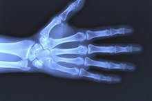 Arthrogram Side Effects