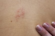 How to Get Rid of Shingle Scars
