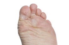 Foot Calluses & Duct Tape