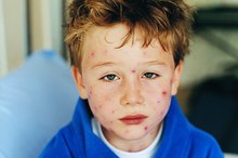 How to Stop Itching Under the Hair From Chicken Pox