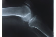 What Is Subchondral Sclerosis?