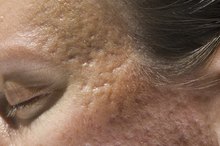 How Do I Get Rid of Acne Craters in the Face?