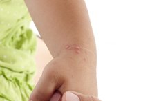 Causes of a Rash on the Hands of a Child
