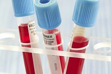 Iron Deficiency, Anemia & Sores