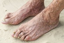Can Peroxide Treat Nail Fungus?