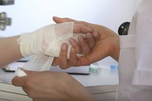 How to Soothe Burns