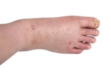 A List of Autoimmune Water Retention Diseases