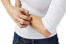Gluten Intolerance, Skin Hives & Hemochromatosis