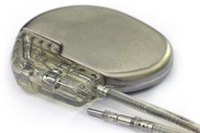 Side Effects of Exercise With a Cardiac Pacemaker