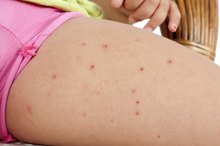 Small Red Bumps on the Leg of a Child