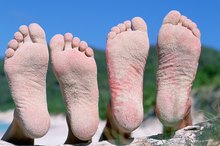 Salicylic Acid & Heel Cracks