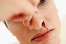 Nosebleeds During Exercise