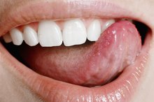 What Are the Causes of Tongue Skin Tags?