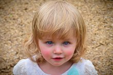 Difference Between Rosy Cheeks & Rosacea