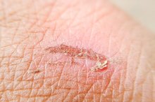 How to Get Rid of Dark Scarring