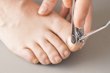 What Causes Nail Fungus to Itch?