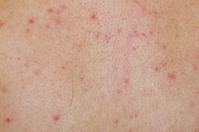 Does Gluten Sensitivity Cause a Rash?