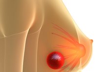 Characteristics of Breast Cancer Lumps