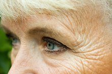 Facial Signs of Stroke