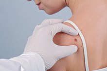 How to Freeze Skin Moles
