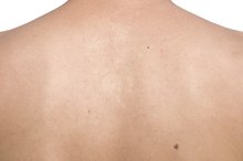 Bumps in a Circle on the Skin