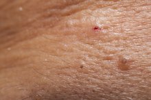 Yasmin Birth Control & Acne