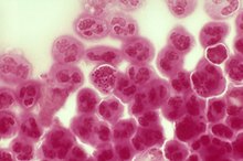 Can Cranberry Juice Treat Gonorrhea?