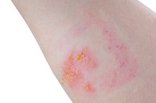 Skin Repair After Poison Ivy
