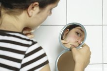 7-Day Detox Treatment for Acne