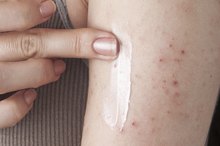 Paw Paw Ointment Vs. Cream for Eczema