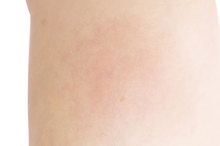 How to Reduce Feet Swelling with Oral Vitamins
