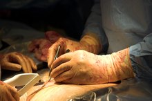Reaction to an Incision Closed With Staples